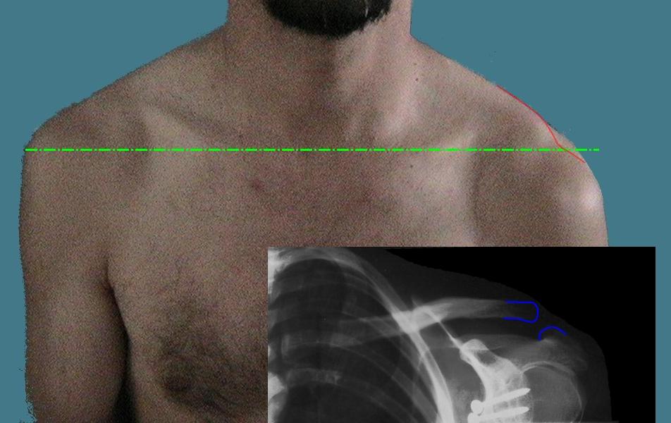 Separated Shoulder